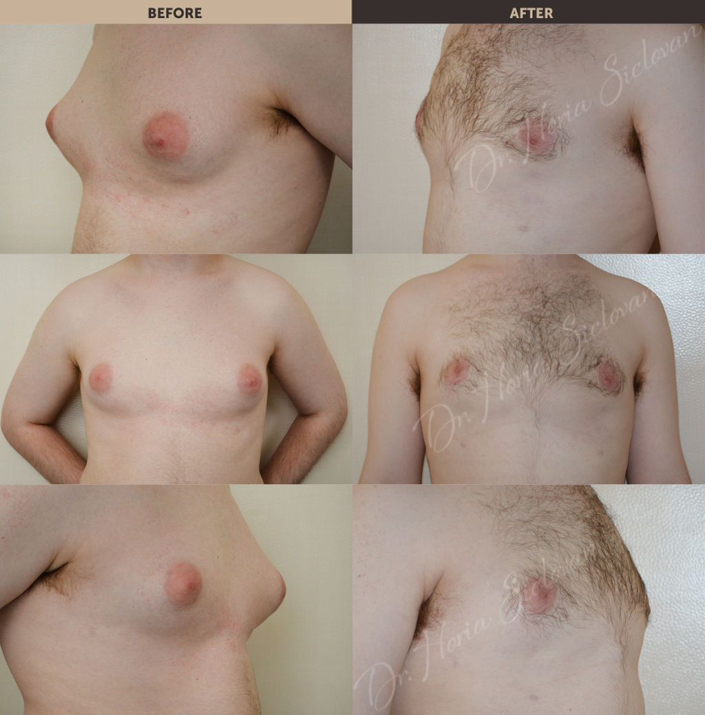 изменение груди у мужчин фото 35