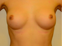 Case 61: Muscle splitting biplane breast augmentation, Mentor® anatomical implants 260 cc